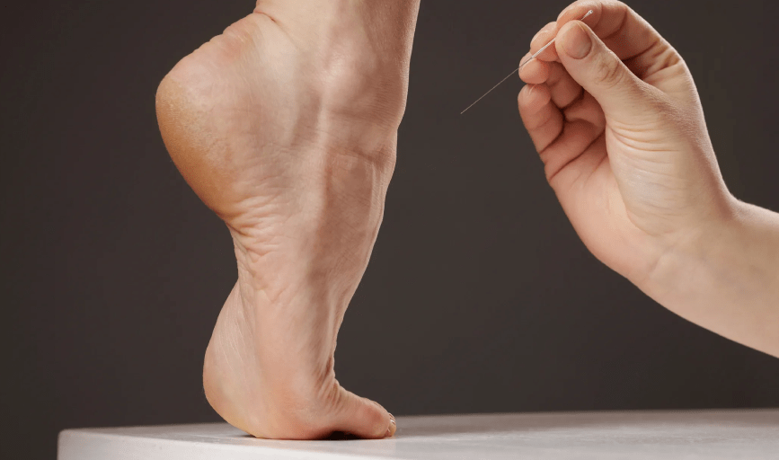DRY NEEDLING